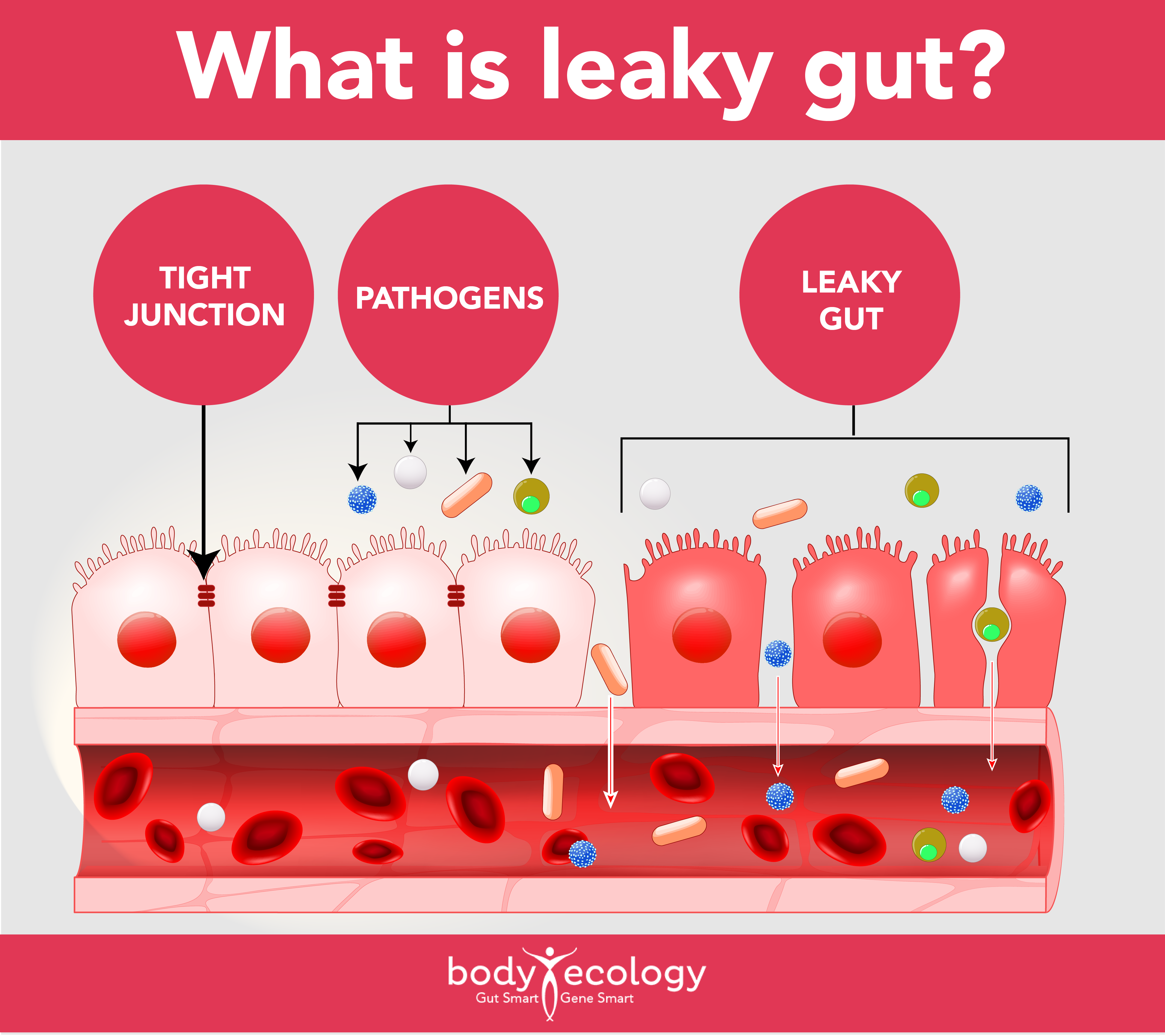 what helps leaky gut